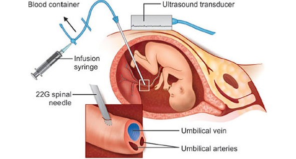 IUT - Intrauterine Fetal Blood Transfusion