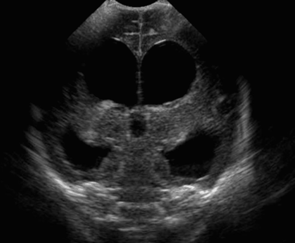 Neurosonogram